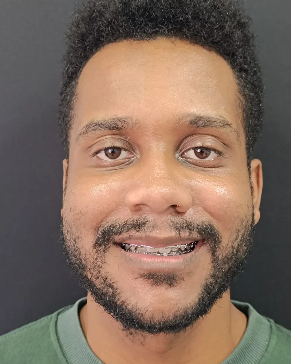 Cirurgia ortognática — Vista frontal — depois