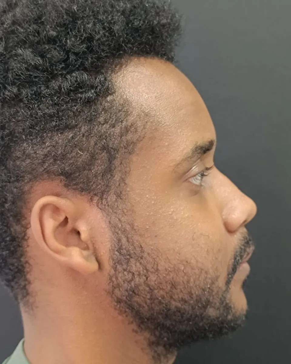 Cirurgia ortognática — Perfil direito — depois