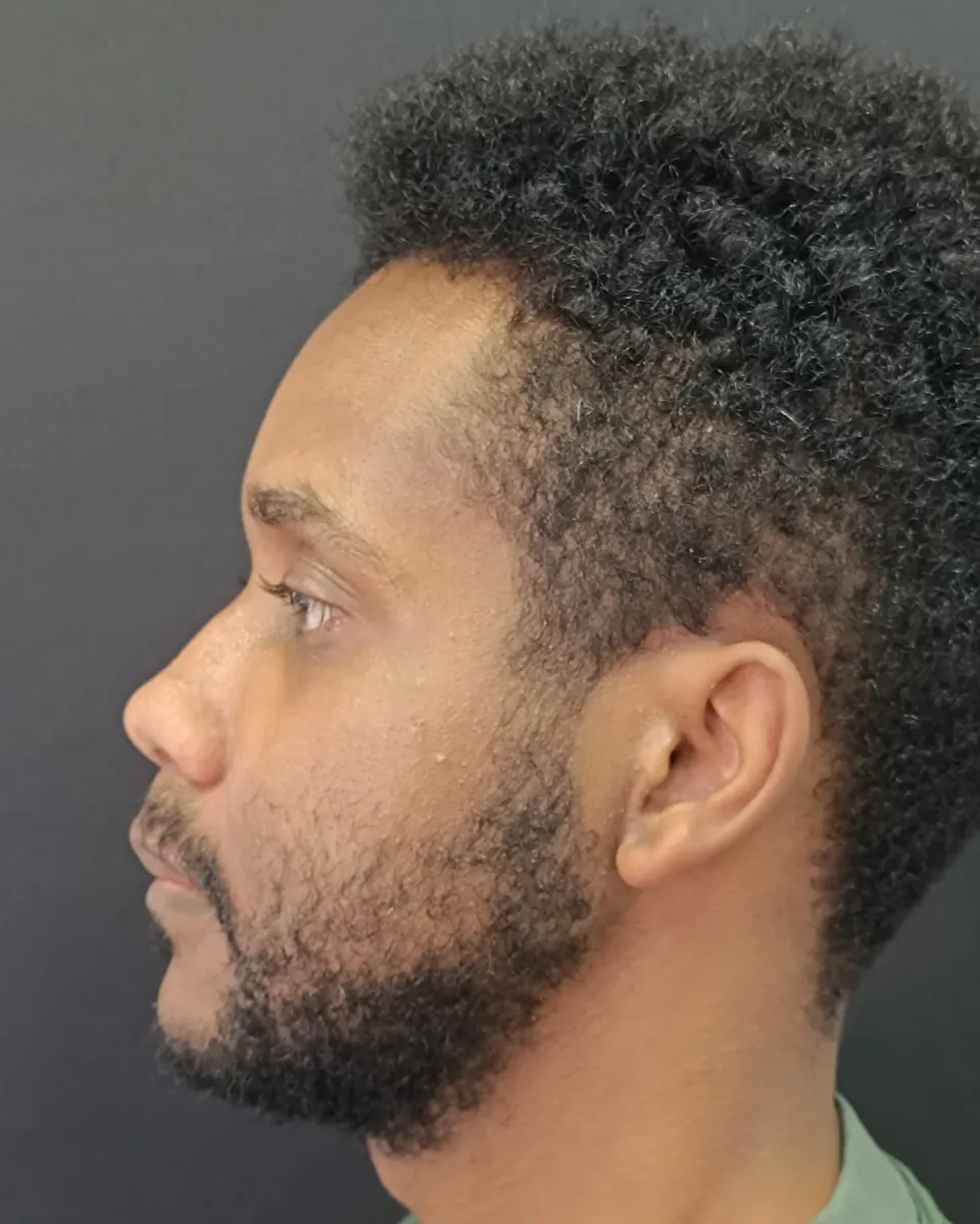 Cirurgia ortognática — Perfil esquerdo — depois