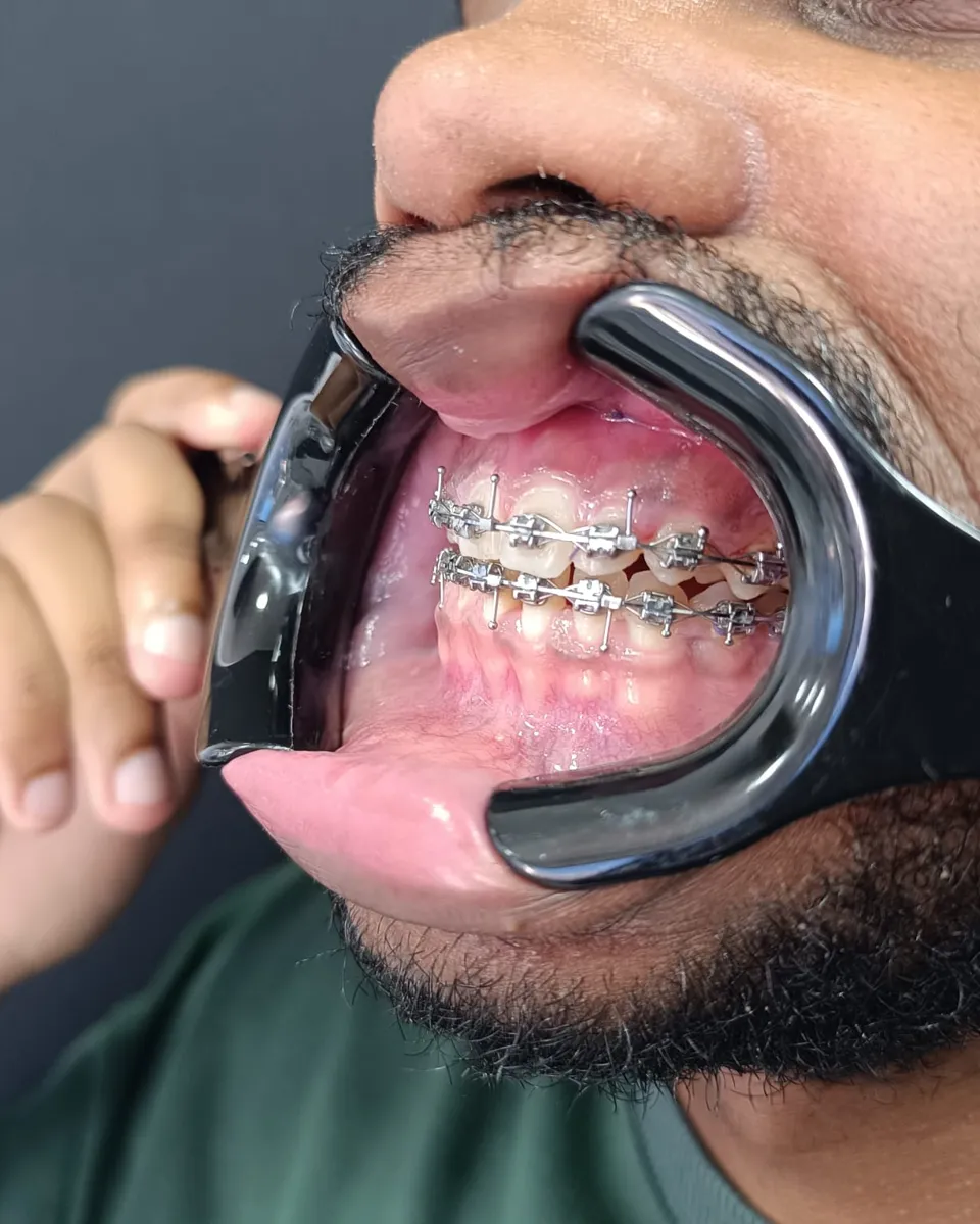 Cirurgia ortognática — Mordida — depois
