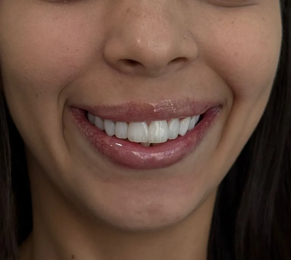 Reabilitação estética anterior, depois