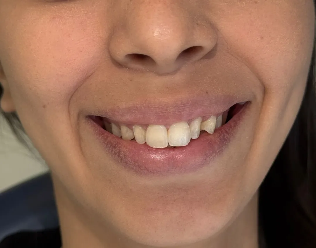 Reabilitação estética anterior, antes