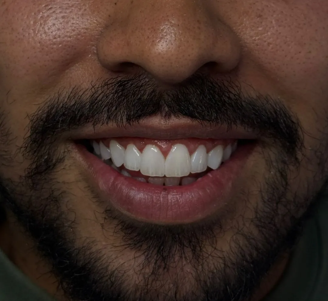 Fechamento de diastema, depois