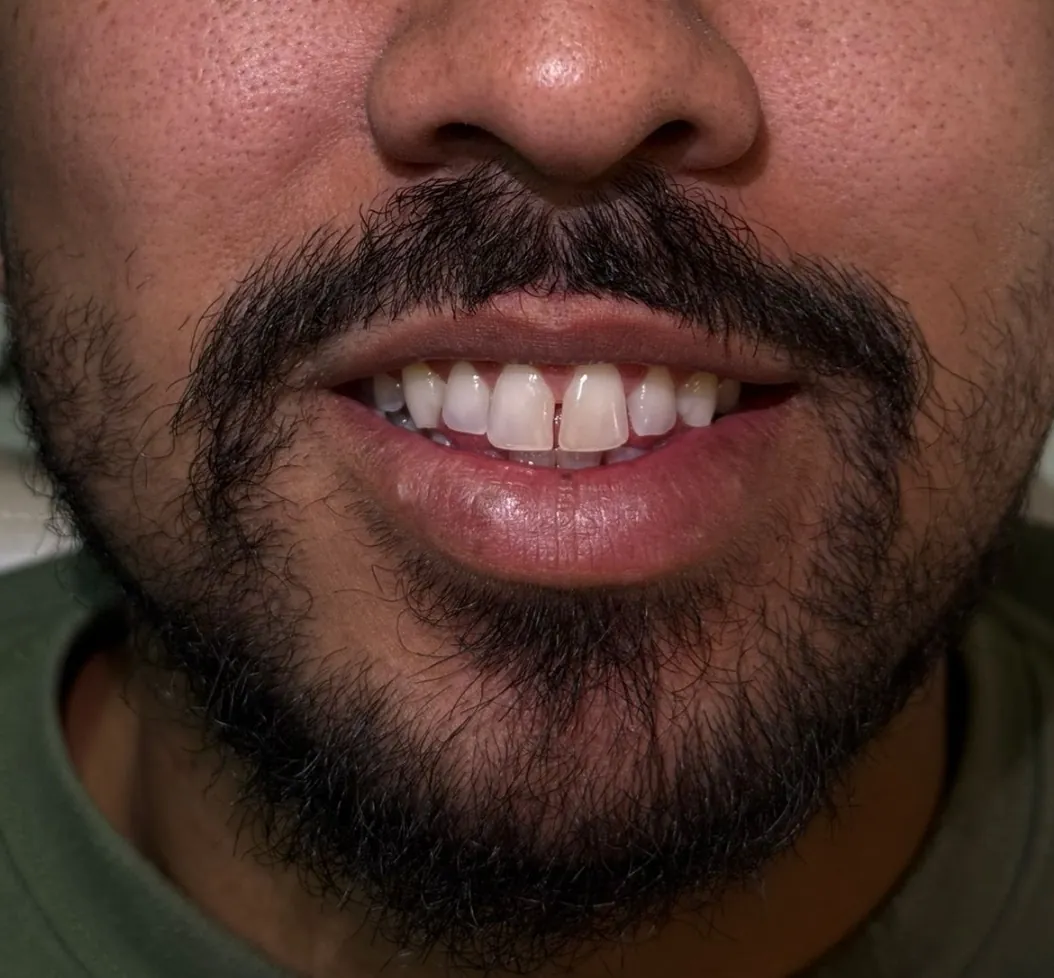 Fechamento de diastema, antes