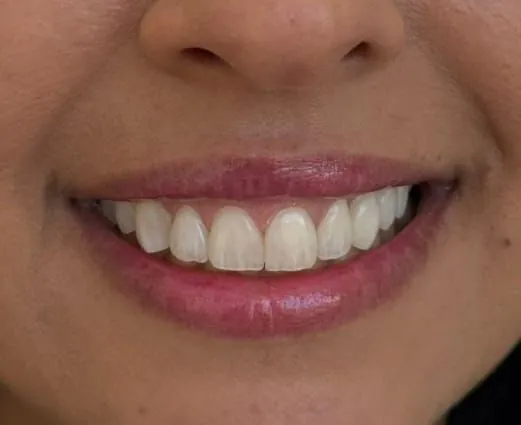 Harmonização do sorriso, depois