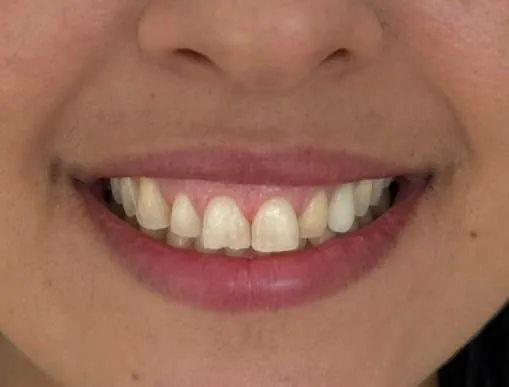 Harmonização do sorriso, antes