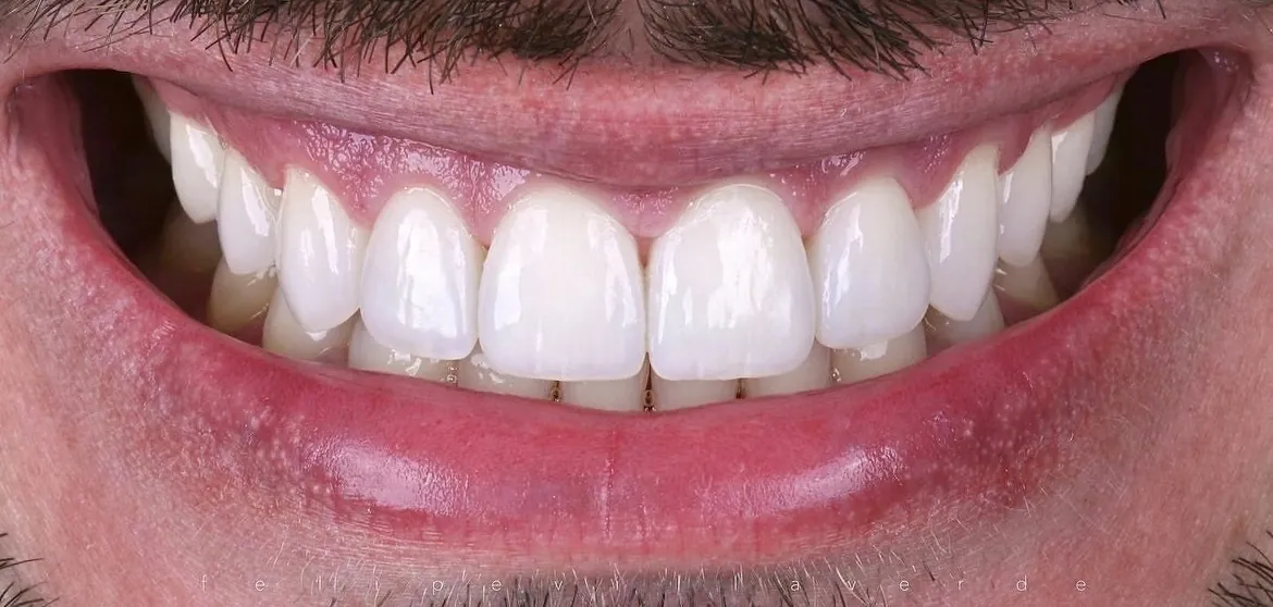 Reconstrução do sorriso, depois