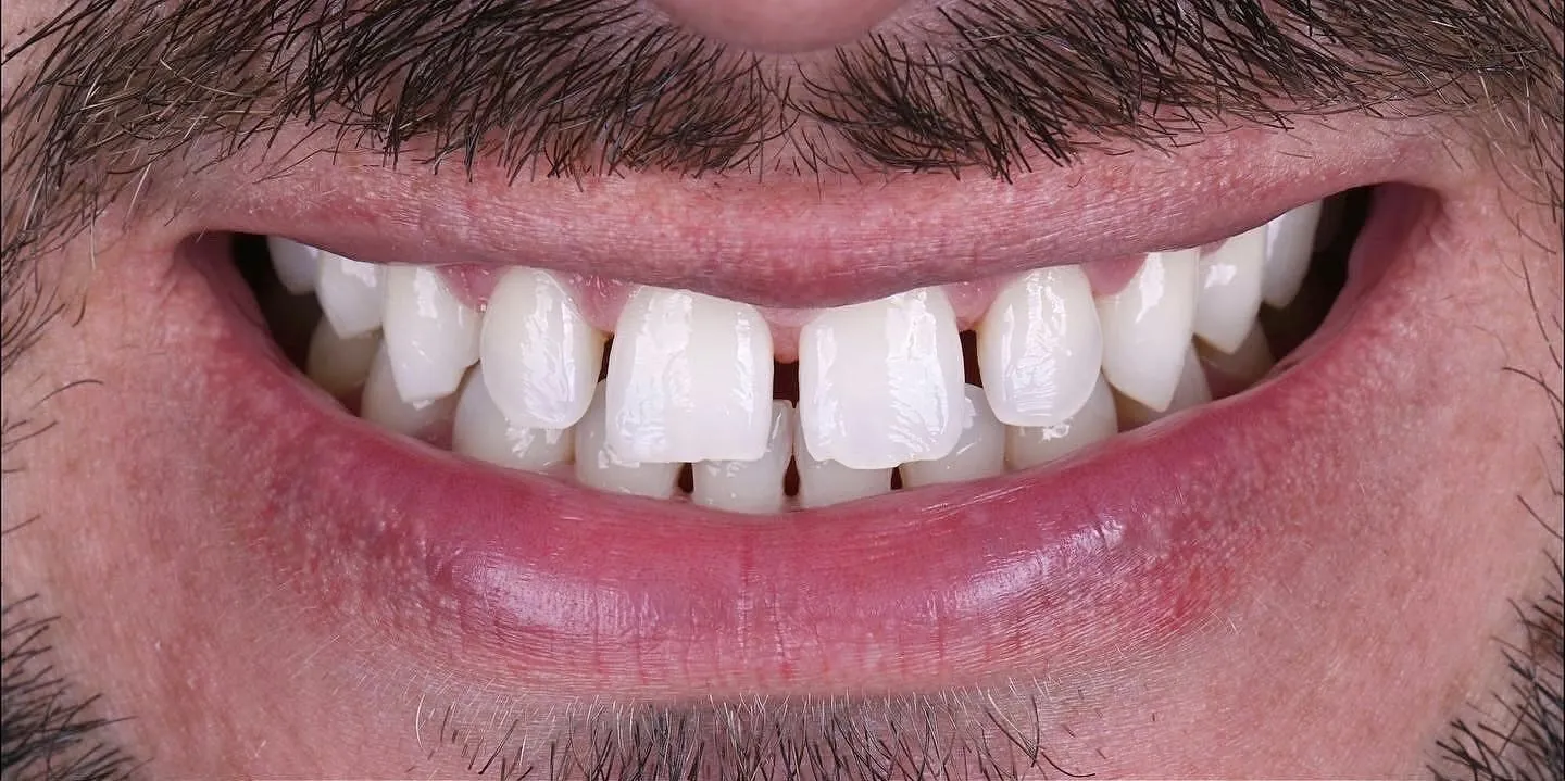Reconstrução do sorriso, antes