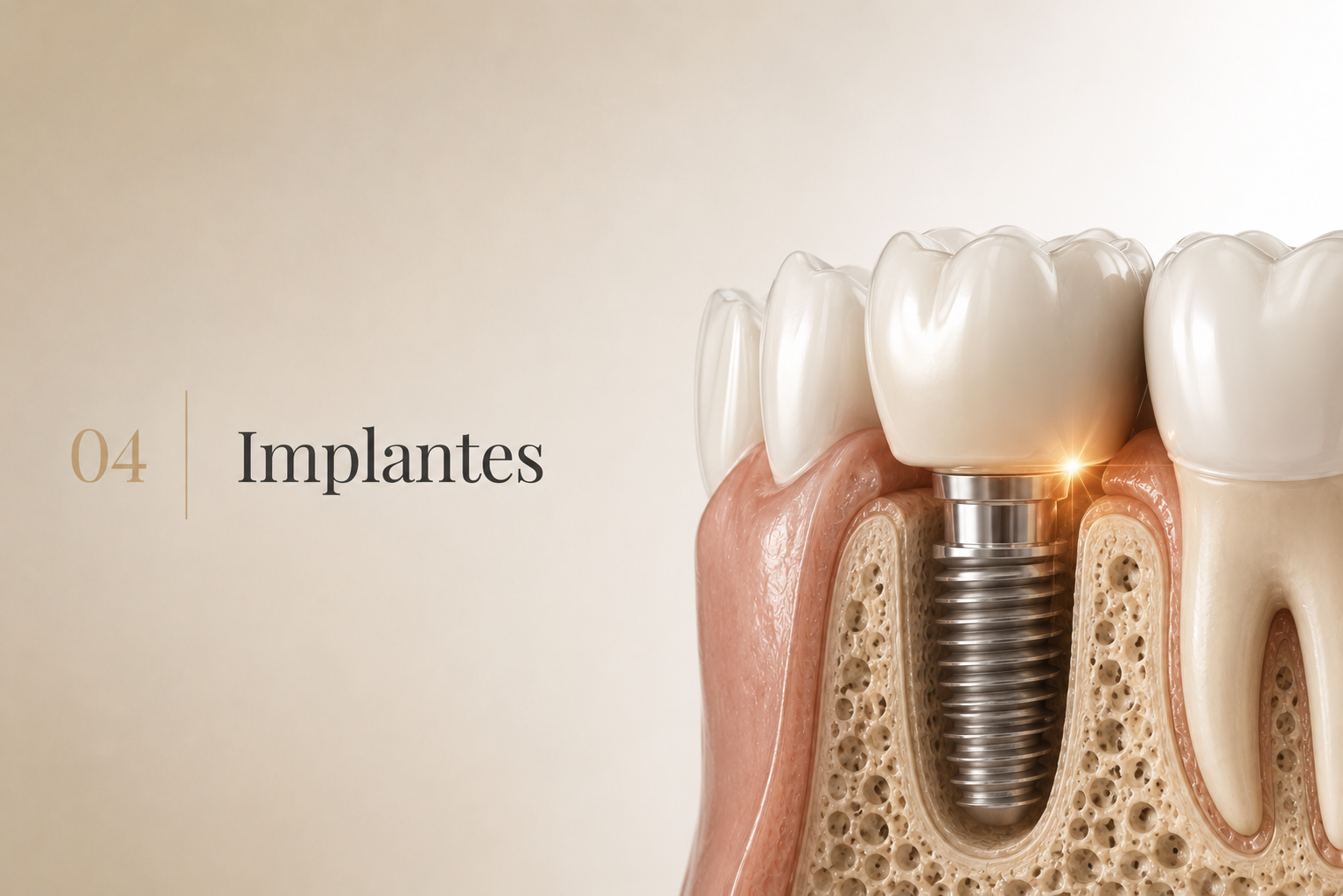 Ilustração editorial — Implantes